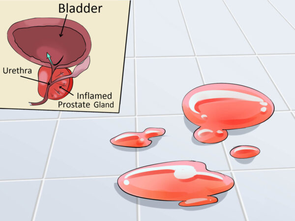 Blood in semen or urine