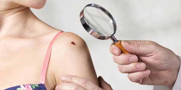 preventing skin cancer