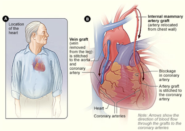 Brief Overview of CABG