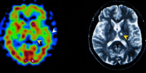 brain spect imaging