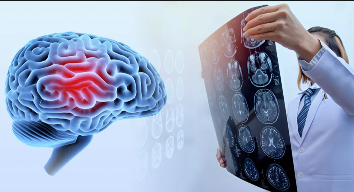 Brain-Based Treatment
